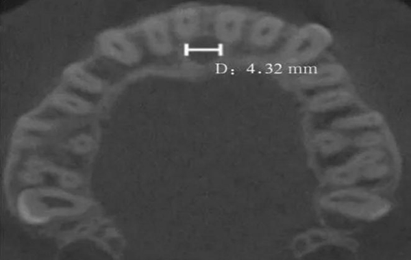 正常人群上頜前牙區鼻腭管相關解剖結構的錐形束CT研究