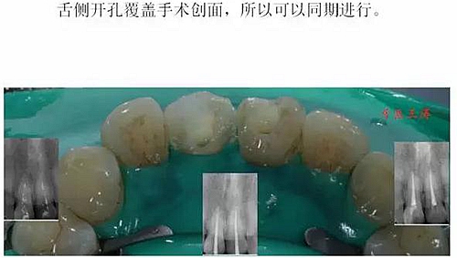 前牙外傷冠延長+全瓷冠修復