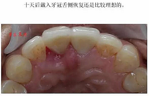 前牙外傷冠延長+全瓷冠修復