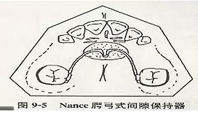 【牙醫干貨】各種間隙保持器賞析