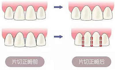 醫(yī)生方案里的鄰面去釉，究竟是什么？