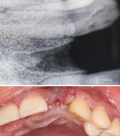 一例上前牙種植失敗病例的補(bǔ)救