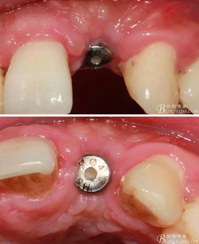 一例上前牙種植失敗病例的補(bǔ)救