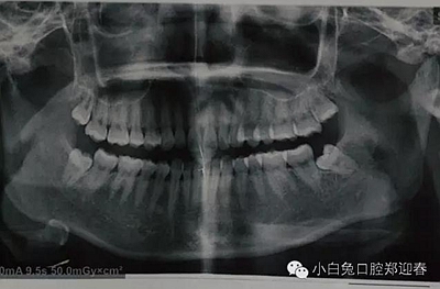 (原創)//圖解微創舒適拔牙全過程 