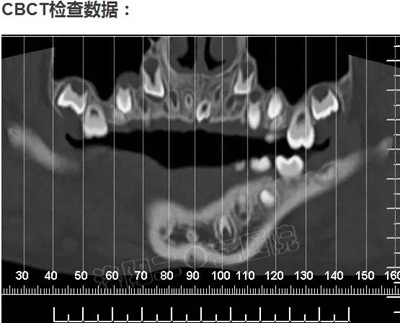 多生牙的拔除總原則：早發現，早處理！