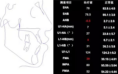 種植釘多維運用矯正高角反頜及開頜—對羅晨醫生專訪及病例展示（上）