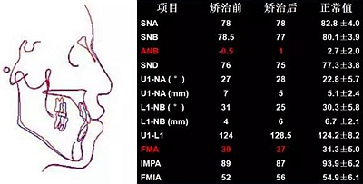 種植釘多維運用矯正高角反頜及開頜—對羅晨醫生專訪及病例展示（上）