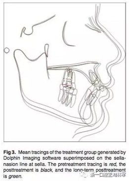 正畸文獻(xiàn)閱讀--用Jasper跳躍矯治器治療II類患者的長期穩(wěn)定性