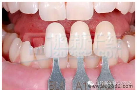 義獲嘉 Ivoclar Vivadent 比色板 A-D16色 Ivoclar Shade Guide A-D16