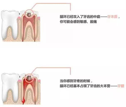 【收藏】關(guān)于補牙，知道這些就夠了！