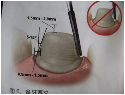 醫(yī)生，我的烤瓷牙上有個(gè)黑線怎么回事？