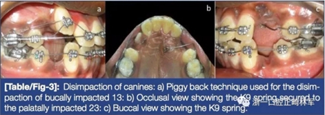 文獻優秀正畸病例賞析--牙周加速成骨正畸（PAOO）輔助的腭側埋伏尖牙牽引矯治及5年跟蹤隨訪