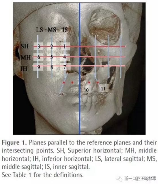 正畸文獻(xiàn)閱讀--無癥狀單側(cè)唇腭裂患者面中部不對稱的三維分析