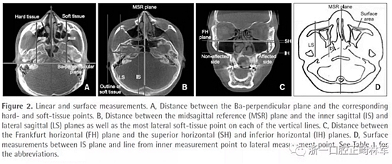 正畸文獻(xiàn)閱讀--無癥狀單側(cè)唇腭裂患者面中部不對稱的三維分析