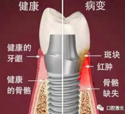 種植體周圍炎的激光療法