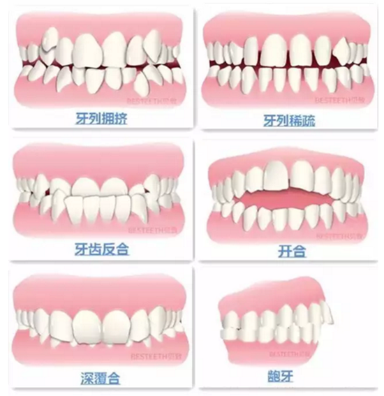 【口腔科普】關于矯牙前、中、后需要注意的問題，了解一下？