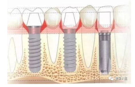 如何選擇種植牙，給《患者》推薦這篇文章就足矣