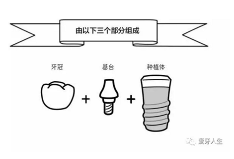 如何選擇種植牙，給《患者》推薦這篇文章就足矣