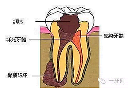 詳解牙疼的原因分幾種？