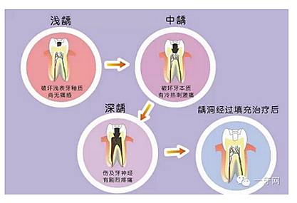 詳解牙疼的原因分幾種？