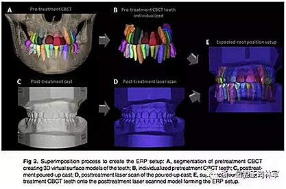 正畸文獻閱讀--正畸過程中牙根移動的三維監(jiān)測