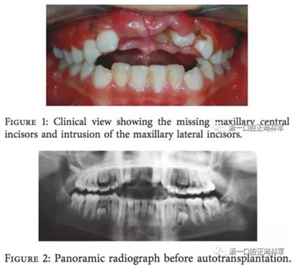 文獻優秀正畸病例賞析--上頜中切牙區受傷后自體牙移植及正畸治療13年隨訪病例