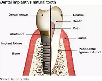 種植體，在全球牙科設備市場的變化！