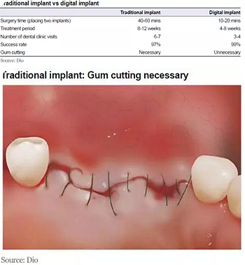 種植體，在全球牙科設備市場的變化！