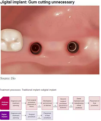 種植體，在全球牙科設備市場的變化！