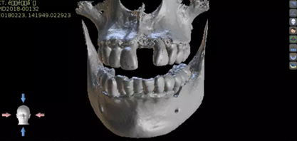 數(shù)字化修復病例分享 | 21單顆牙齒種植修復
