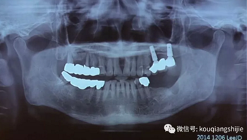 拔牙窩的處理-新思路