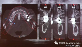 拔牙窩的處理-新思路