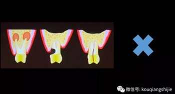 拔牙窩的處理-新思路