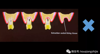 拔牙窩的處理-新思路