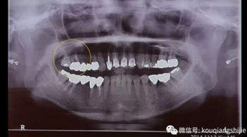 拔牙窩的處理-新思路