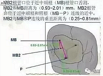 根管治療常見的難點(diǎn)與解決方案