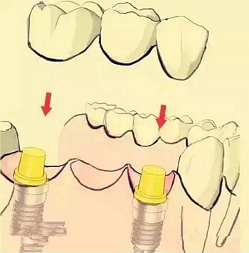 【牙齒種植】健康牙齒“種”出來