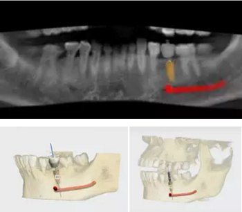 【病例分享】Implant Guide?數字化全程導航及椅旁即刻修復一例