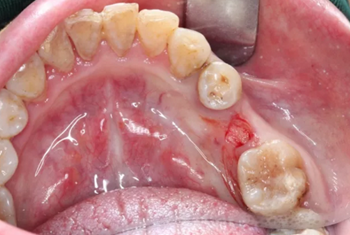 【病例分享】Implant Guide?數字化全程導航及椅旁即刻修復一例