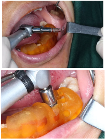 【病例分享】Implant Guide?數字化全程導航及椅旁即刻修復一例