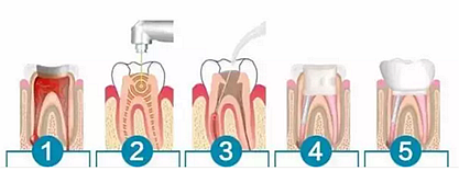 【科普】牙齒根管治療大全