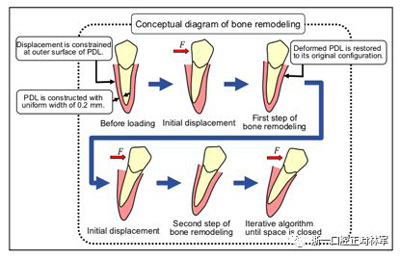 正畸文獻閱讀--對于滑動法關閉間隙的有限元分析