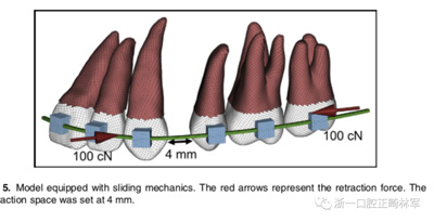 正畸文獻閱讀--對于滑動法關閉間隙的有限元分析