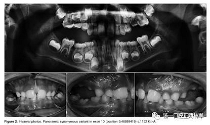 正畸文獻閱讀--原發性萌出失敗：混合牙列的臨床和遺傳學研究