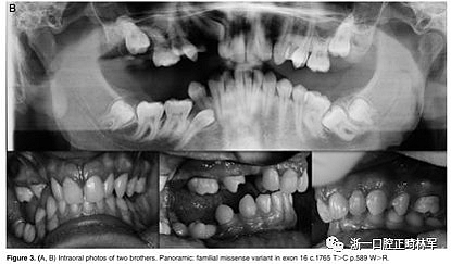 正畸文獻閱讀--原發性萌出失敗：混合牙列的臨床和遺傳學研究
