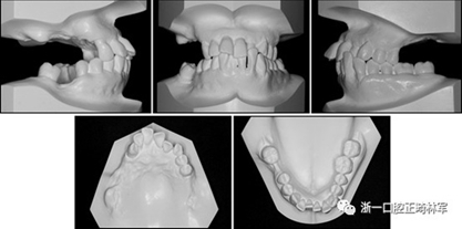 文獻優秀正畸病例賞析--多顆牙齒缺失的牙周炎患者的跨學科綜合治療