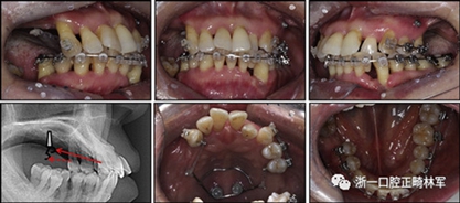 文獻優秀正畸病例賞析--多顆牙齒缺失的牙周炎患者的跨學科綜合治療
