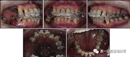 文獻優秀正畸病例賞析--多顆牙齒缺失的牙周炎患者的跨學科綜合治療