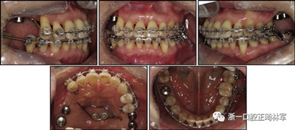 文獻優秀正畸病例賞析--多顆牙齒缺失的牙周炎患者的跨學科綜合治療