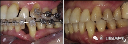 文獻優秀正畸病例賞析--多顆牙齒缺失的牙周炎患者的跨學科綜合治療